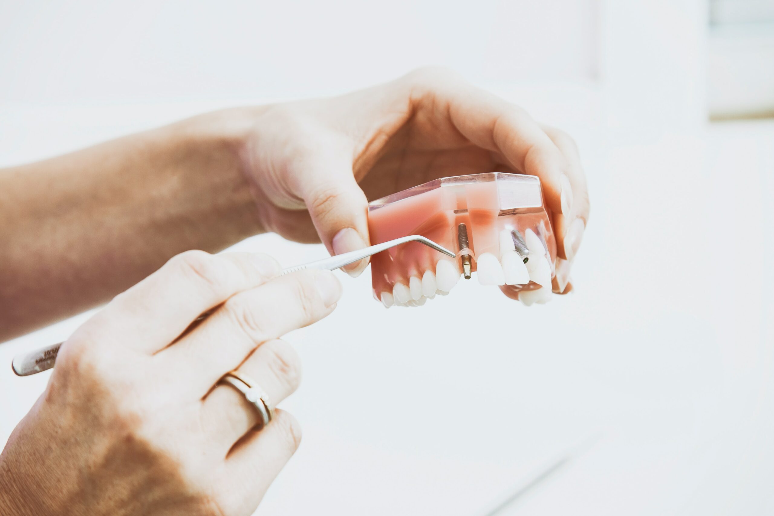 Dental implant model