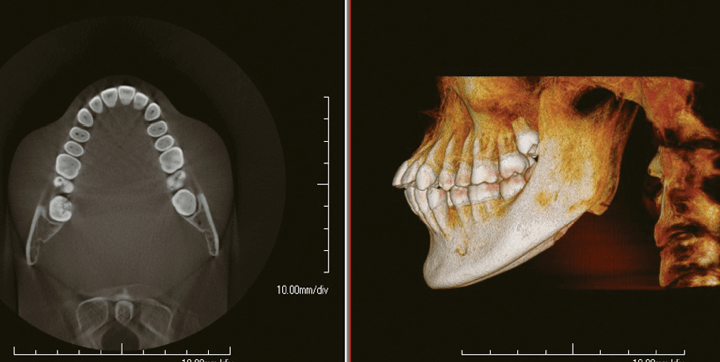 PreXion dental 3d imaging technology