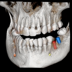 3d implant scan