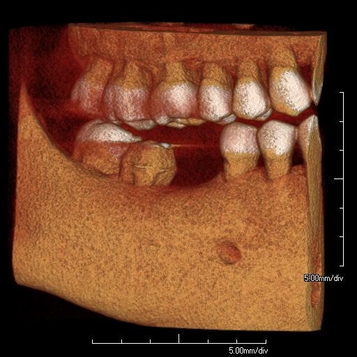 implant scan before