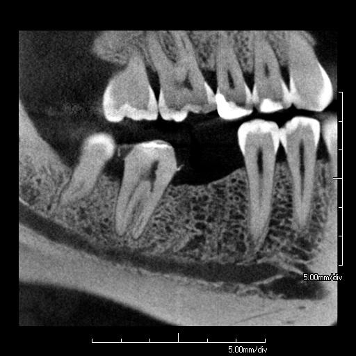 implant scan