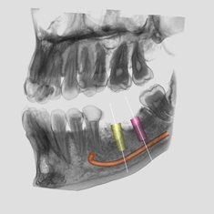 implant scan example 