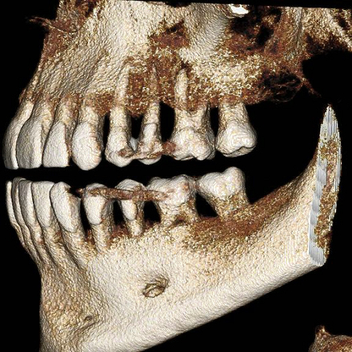 3d periodontics cbct scan