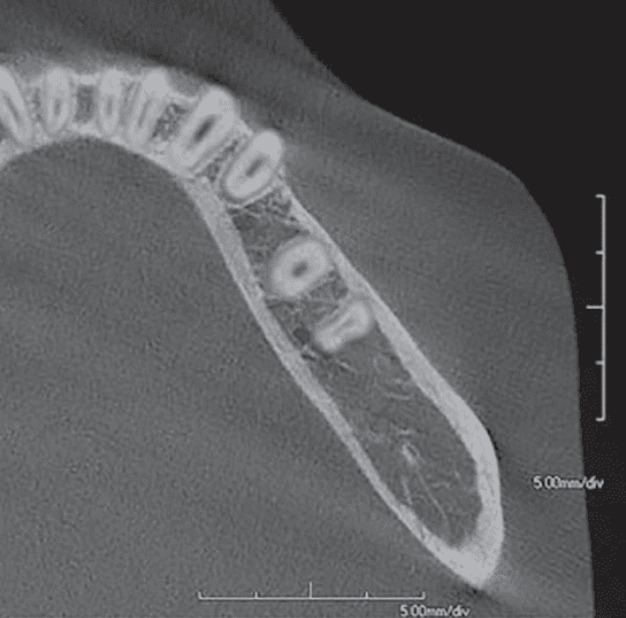 PRE-Focal-2 10x10cm FOV 0.3mm Focal Spot