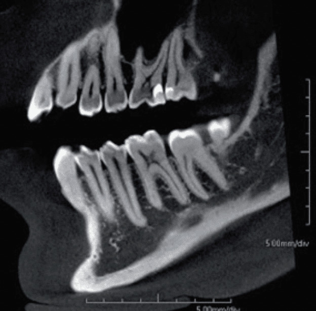 PRE-Focal-4 5x5cm FOV 0.1mm Voxel Size