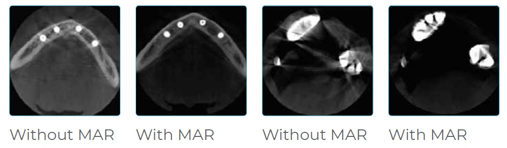 cbct scanner imaging without MAR