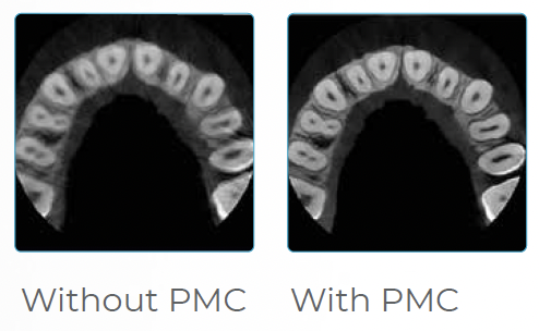 Prexion 3d cbct scanner imaging PMC