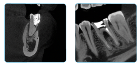 Prexion cbct scanner imaging UHD mode