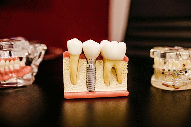 dental implant history