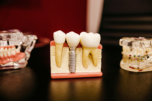 dentalimplants History of Dental Implants